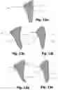 Fig. 07 - Device for the external application of a local compressive force below the costal arch of a patient to reduce the stomach volume