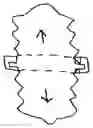 Fig. 01 - Bi-Directional Prophylactic with Band