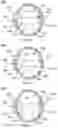 Fig. 06 - Method and apparatus for performing ophthalmic procedures removing undesirable features using laser energy