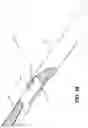 Fig. 09 - Single operator device for delivering an ocular implant