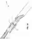 Fig. 10 - Single operator device for delivering an ocular implant