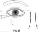 Fig. 11 - Single operator device for delivering an ocular implant