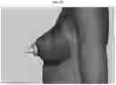 Fig. 11 - BREASTFEEDING DEVICE