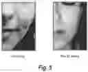 Fig. 06 - Semi-solid topical composition containing pirfenidone and modified diallyl disulfide oxide (M-DDO) for eliminating or preventing acne