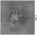 Fig. 04 - NON-LEAKING OR MINIMALLY-LEAKING CHOROIDAL OR RETINAL REVASCULARIZATION
