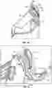 Fig. 16 - Breast pump assembly with remote interface
