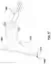 Fig. 14 - Tracheotomy device and method