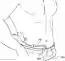 Fig. 01 - Catheter Pouch