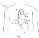 Fig. 02 - Blood clot removal device, system, and method