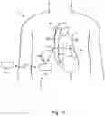 Fig. 08 - Blood clot removal device, system, and method