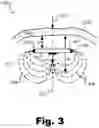 Fig. 04 - Methods and systems for treating osteoarthritis using an implantable stimulator