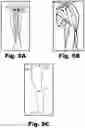 Fig. 06 - Methods and systems for treating osteoarthritis using an implantable stimulator