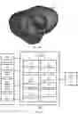 Fig. 05 - Method of cardiac resynchronization therapy