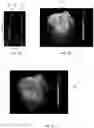 Fig. 10 - Method of cardiac resynchronization therapy