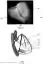 Fig. 14 - Method of cardiac resynchronization therapy
