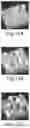Fig. 40 - Nanostructure-reinforced composite articles and methods