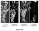 Fig. 08 - Method for Treating Ischemic Tissue