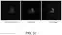 Fig. 29 - Lysosomal storage disease enzymes