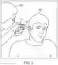 Fig. 03 - Impression procedure