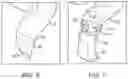Fig. 05 - Impression procedure