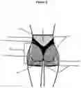 Fig. 03 - Convex Padded Hip Enhancing Garment