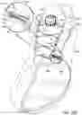 Fig. 22 - Tension member guides for lacing systems