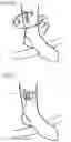 Fig. 62 - Closing device having a winding element