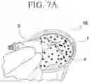 Fig. 11 - Method of estimating blood volume