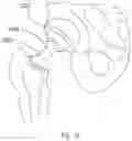 Fig. 14 - In vivo sensor