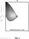 Fig. 05 - Techniques for patient positioning quality assurance prior to mammographic image acquisition