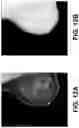 Fig. 13 - Techniques for patient positioning quality assurance prior to mammographic image acquisition