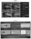 Fig. 33 - Methods and systems to determine cancer molecular subtypes based on ultrasound and/or optoacoustic (OA/US) features