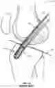 Fig. 18 - Quantitative assessment of implant installation