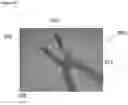 Fig. 04 - Tissue securing device and method of use