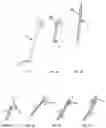 Fig. 02 - Knot-tying device for surgical sutures