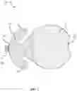 Fig. 04 - Aneurysm device and delivery system