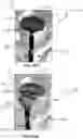 Fig. 11 - Aneurysm device and delivery system