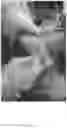 Fig. 13 - Systems, devices, and non-invasive surgical methods for treating plantar fasciitis and chronic heel spur syndrome