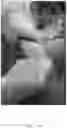 Fig. 14 - Systems, devices, and non-invasive surgical methods for treating plantar fasciitis and chronic heel spur syndrome