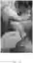 Fig. 16 - Systems, devices, and non-invasive surgical methods for treating plantar fasciitis and chronic heel spur syndrome