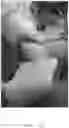 Fig. 17 - Systems, devices, and non-invasive surgical methods for treating plantar fasciitis and chronic heel spur syndrome