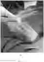 Fig. 20 - Systems, devices, and non-invasive surgical methods for treating plantar fasciitis and chronic heel spur syndrome