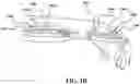 Fig. 05 - External orthopedic fixation device