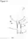Fig. 14 - External fixation for the correction of bone deformity and trauma