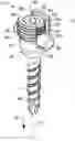 Fig. 01 - Extension-ready spinal support system with vascular-safe pedicle screw