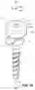 Fig. 15 - Extension-ready spinal support system with vascular-safe pedicle screw