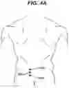 Fig. 05 - Methods and devices for minimally invasive spinal fixation element placement