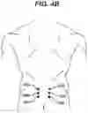 Fig. 06 - Methods and devices for minimally invasive spinal fixation element placement