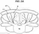 Fig. 07 - Methods and devices for minimally invasive spinal fixation element placement