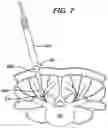 Fig. 10 - Methods and devices for minimally invasive spinal fixation element placement